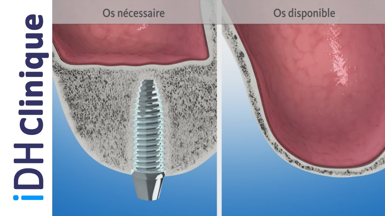 Greffe osseuse au sinus - Sinus-lift - Comblement de sinus