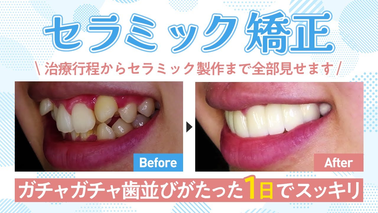 【これでわかるセラミック矯正】ガチャ歯を治して笑顔❤治療・製作風景をしっかり見せます【湘南美容クリニック・歯科仙台院柿野医師・歯科矯正】