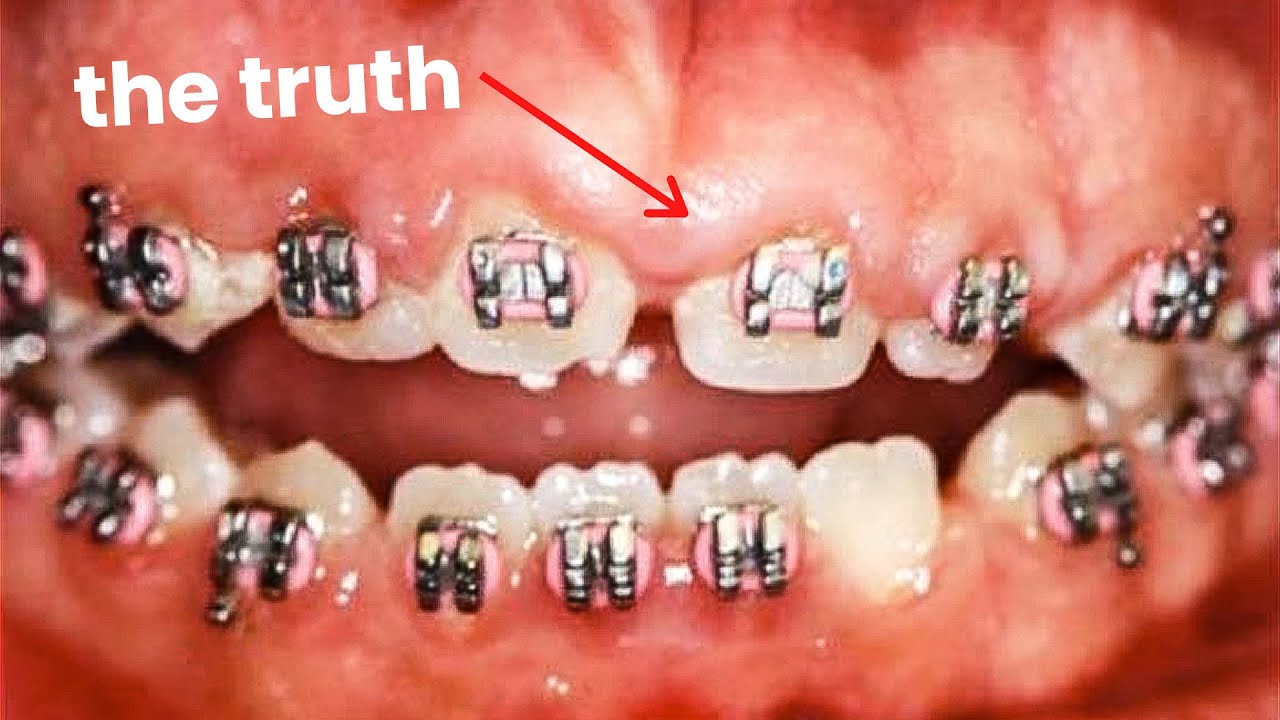 The Risks of Getting Braces...