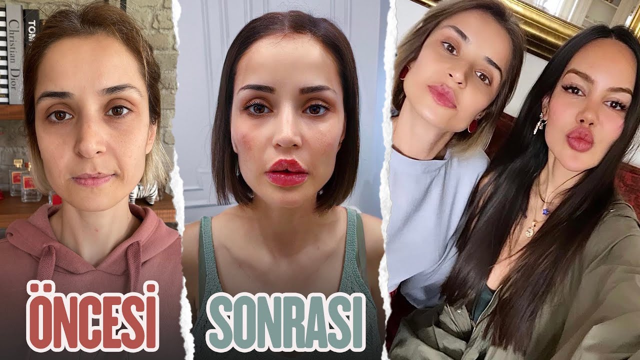 ARKADAŞIMI BAŞTAN YARATTIM! Dolgu, Botoks, Estetik...