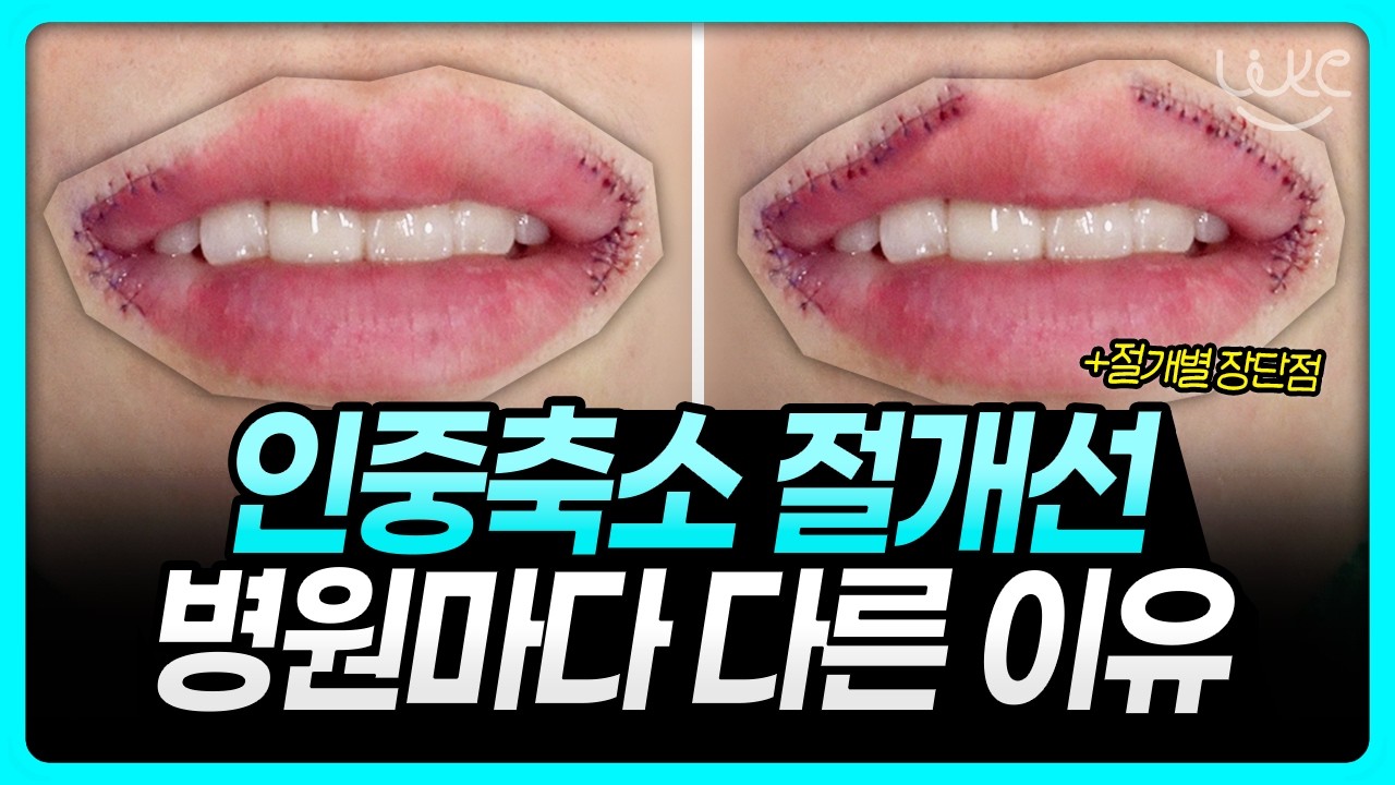 같은 인중축소 수술인데 왜 절개선이 다를까?