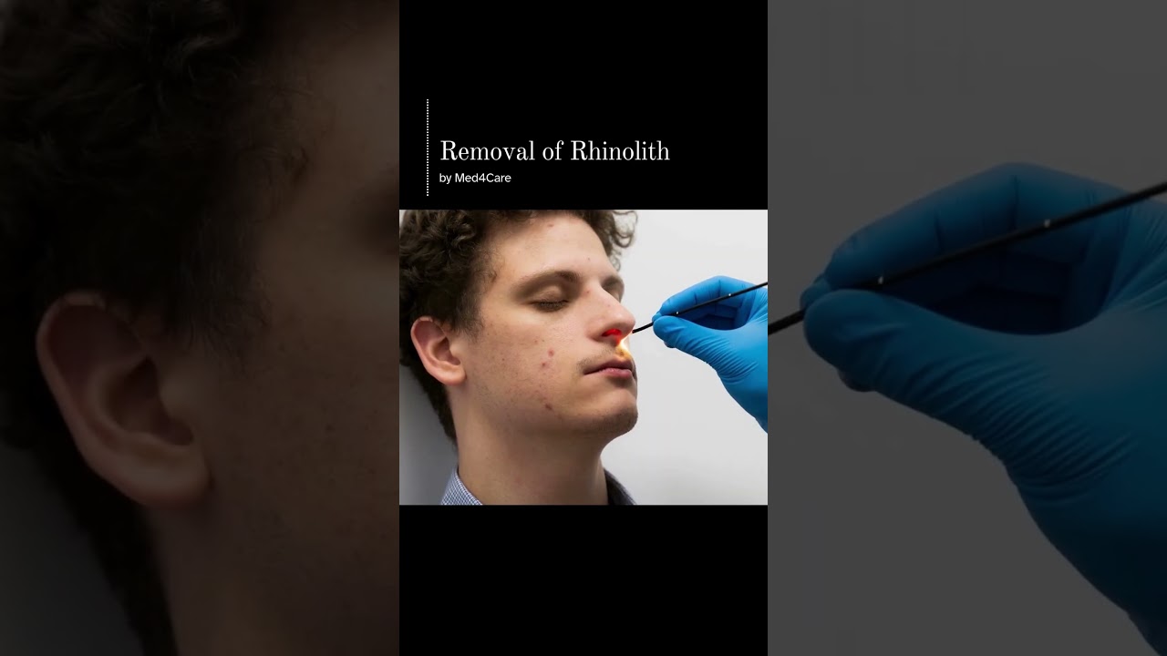 Removal of Rhinolith