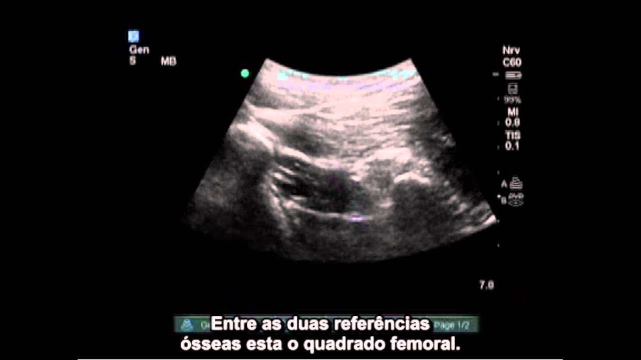Anestesia - EDU00170 Como Fazer: Uso do Ultrassom SonoSite em Bloqueio do Nervo Ciático