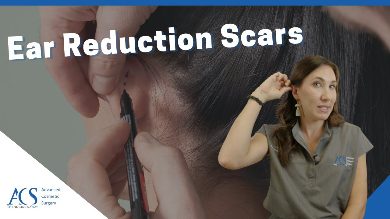 Otoplasty Surgery Scars: Will They Be Visible, Are They Painful, and When Will They Disappear?