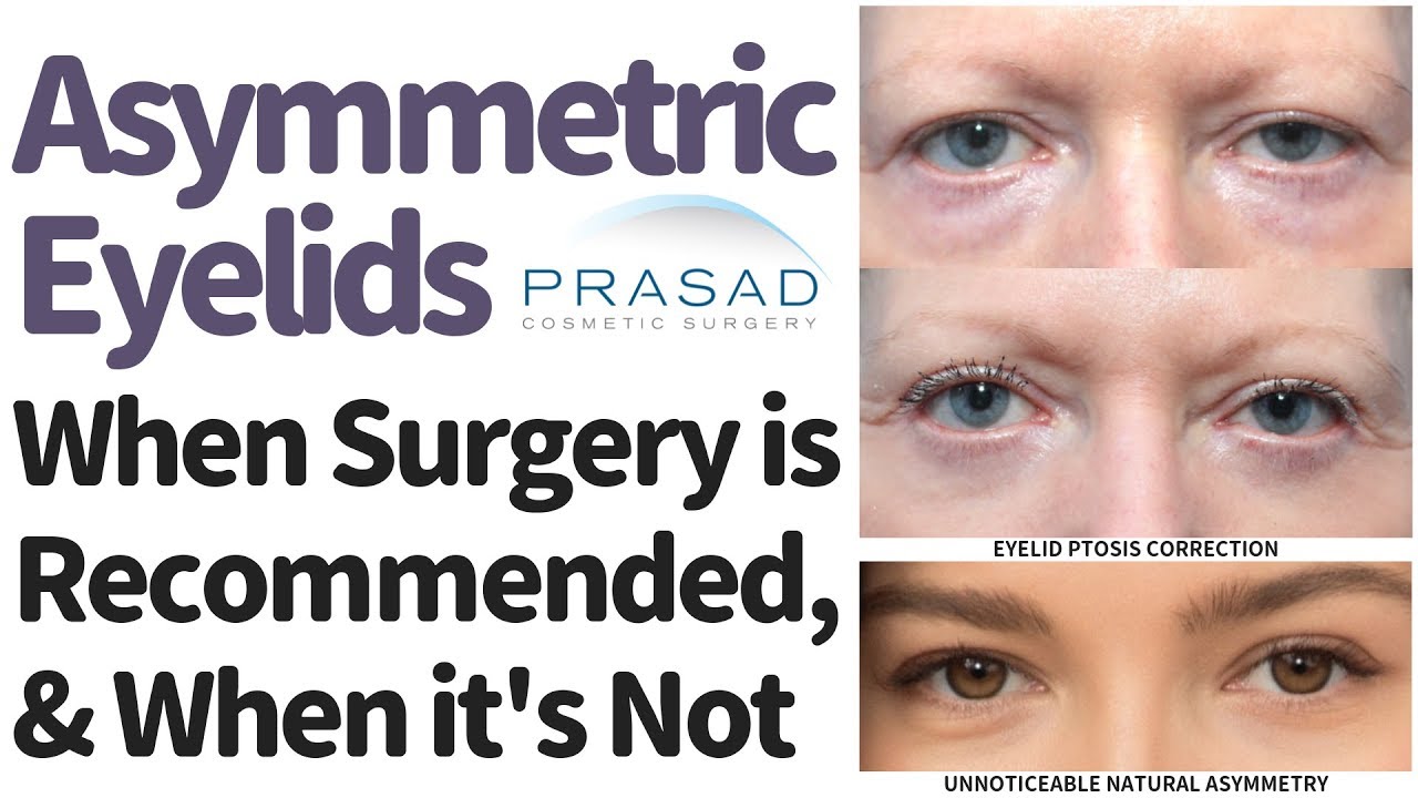 Asymmetrical Eyelids - When Natural Asymmetry Doesn't Need Surgery, and When Surgery is Advised