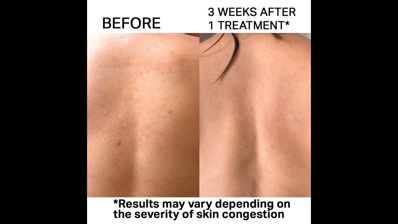 Bacne Facial Treatment with Hydrafacial – Clearer Back After Just 1 Session at Beyond Facials