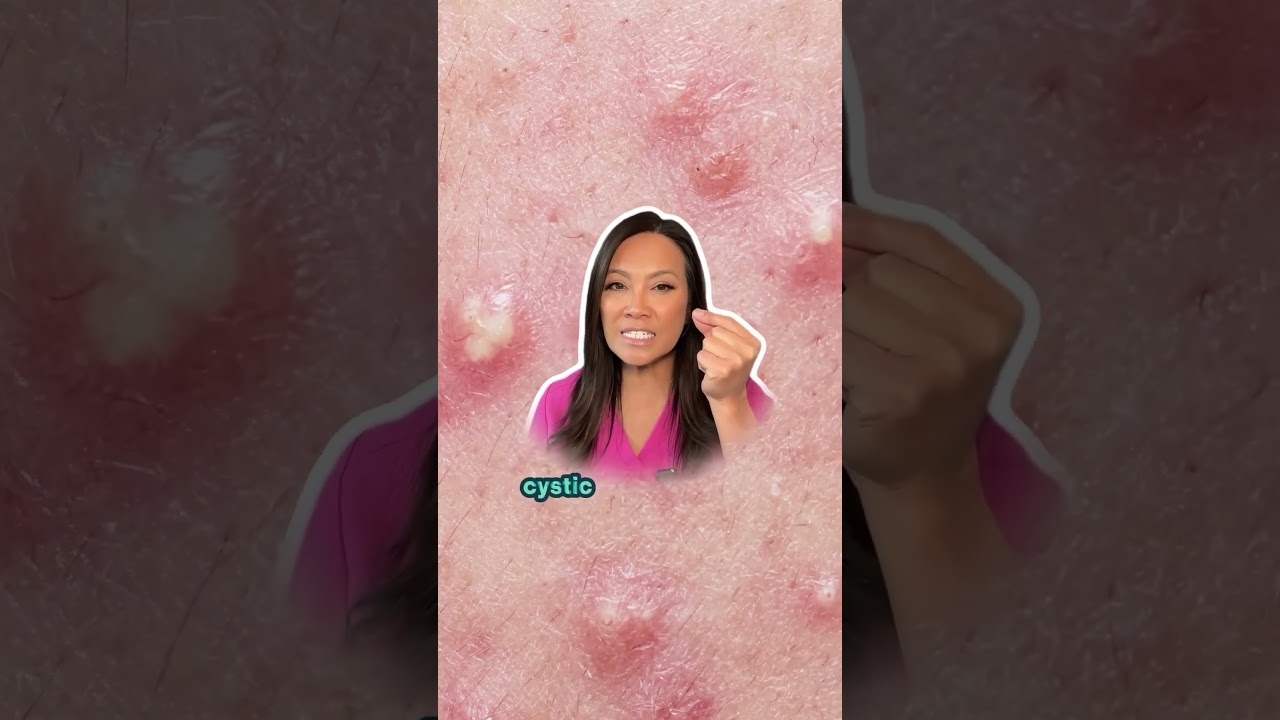 OTC solutions help mild acne without dermatologist