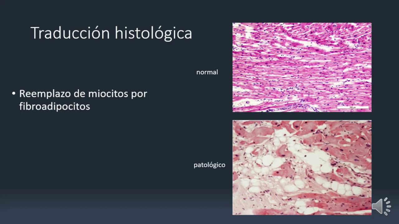 Miocardiopatía Arritmogénica