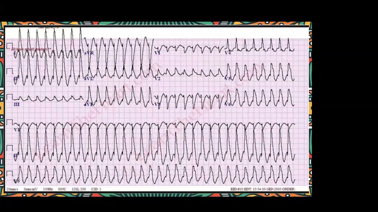 EKG1: Electrifying Insights: Exploring EKG Basics and Rhythms - Parag Patel - Global FICCS