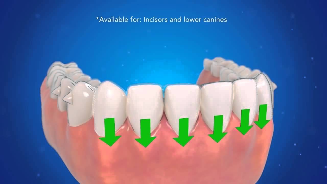Inovações Invisalign G5 para Mordida Profunda