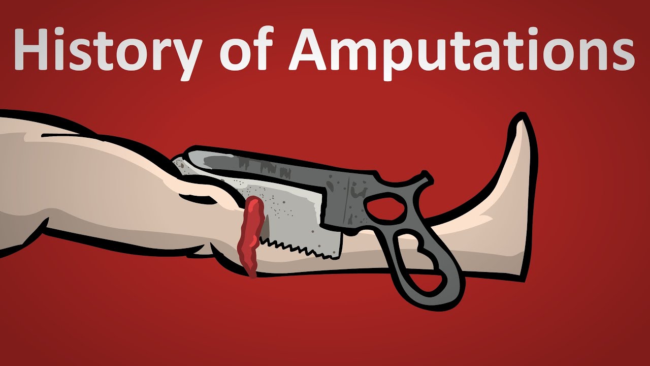 The History of Amputation Explained
