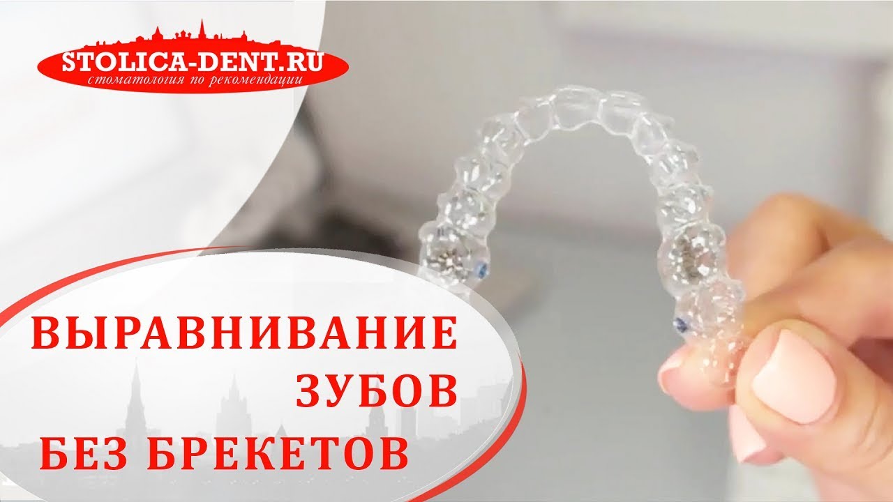 🤔 Что такое invisalign и как работает данная система. Invisalign как работает. Столица. 12+