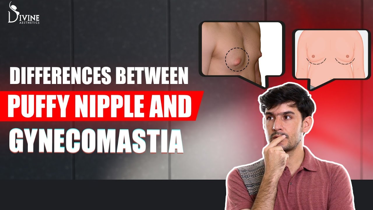 Puffy Nipples vs. Gynecomastia: Key Differences and Treatment Options