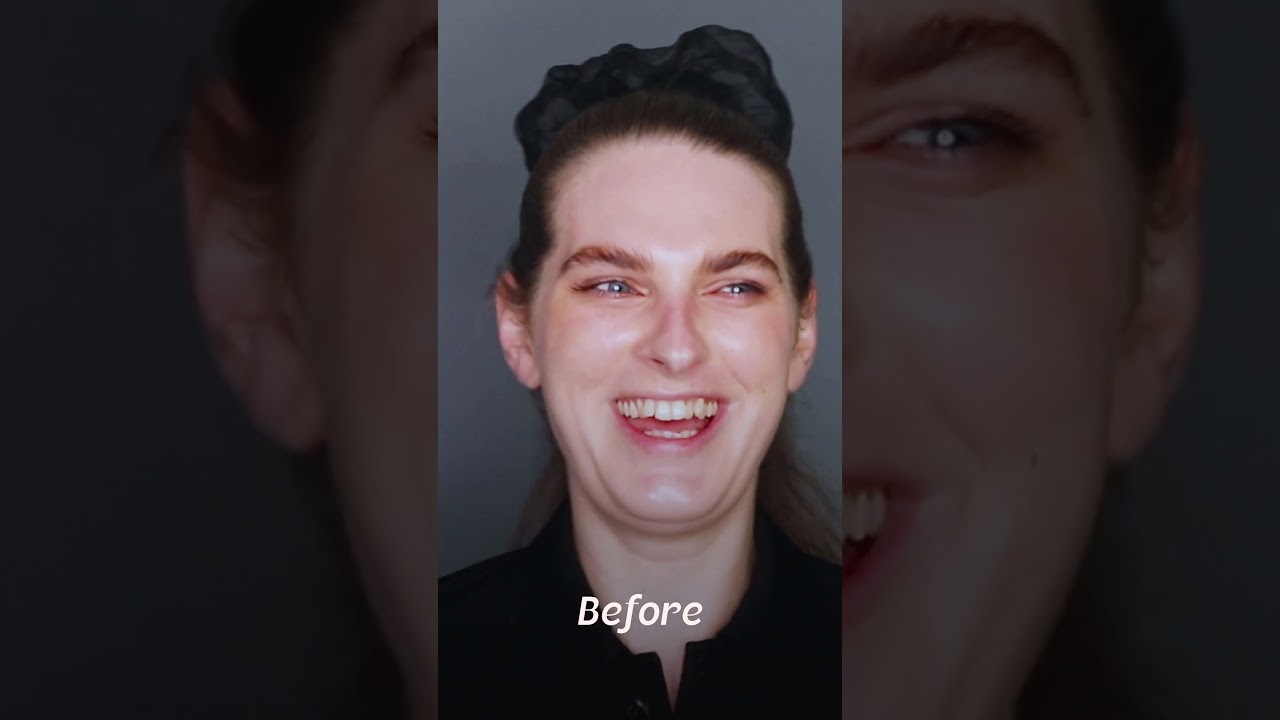 Jade, Australia &mdash; FFS Surgery Stories
