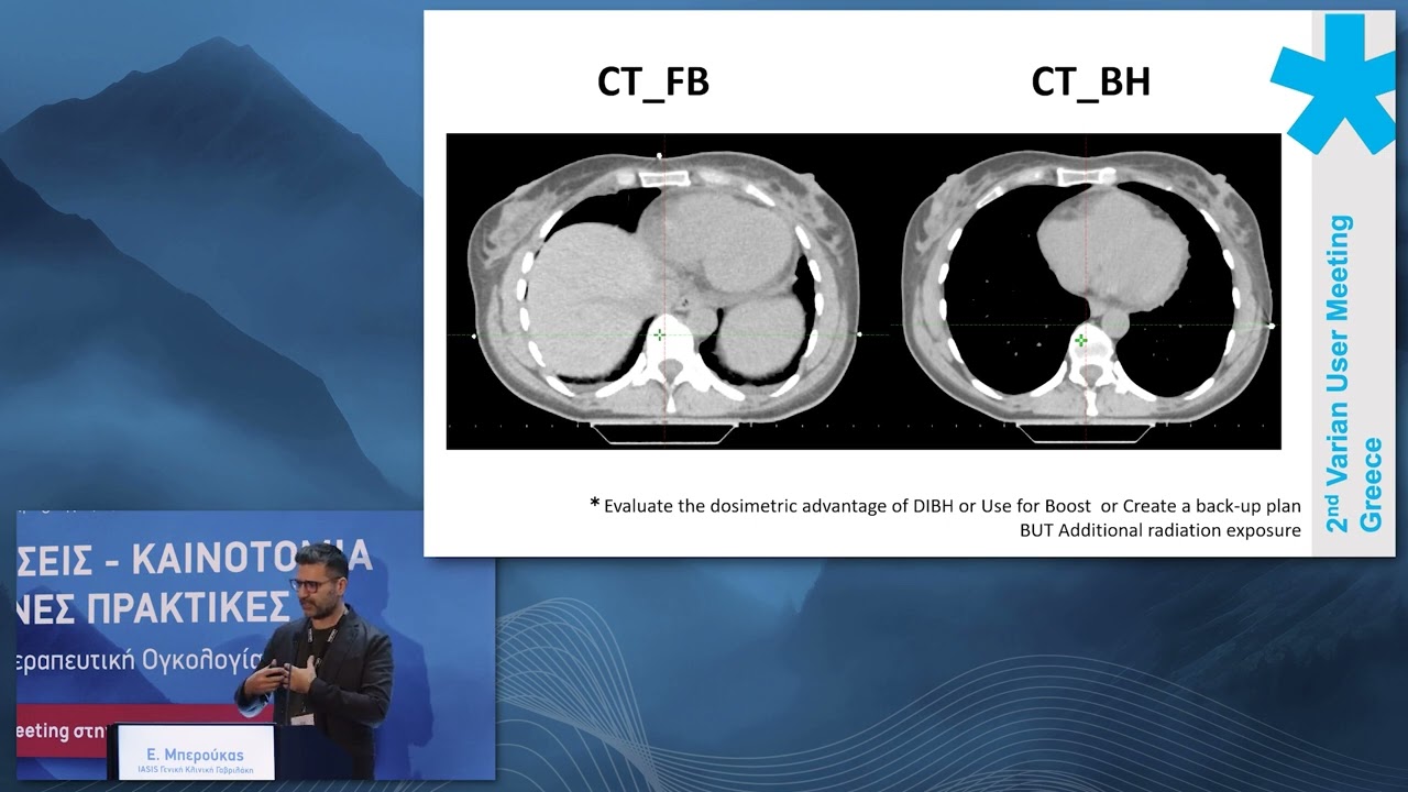 DIBH:Techniques and advantages for cardiac sparing during breast radiotherapy treatments- E.Beroukas