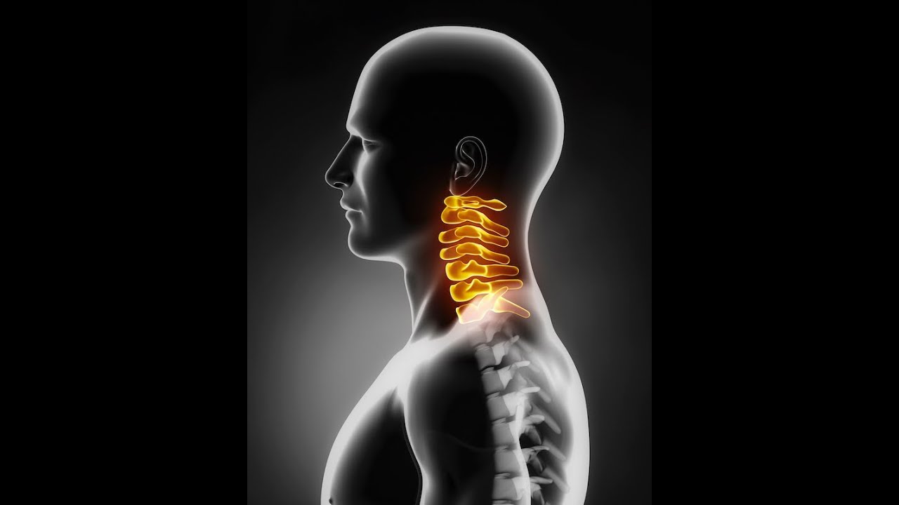Posterior cervical foraminotomy