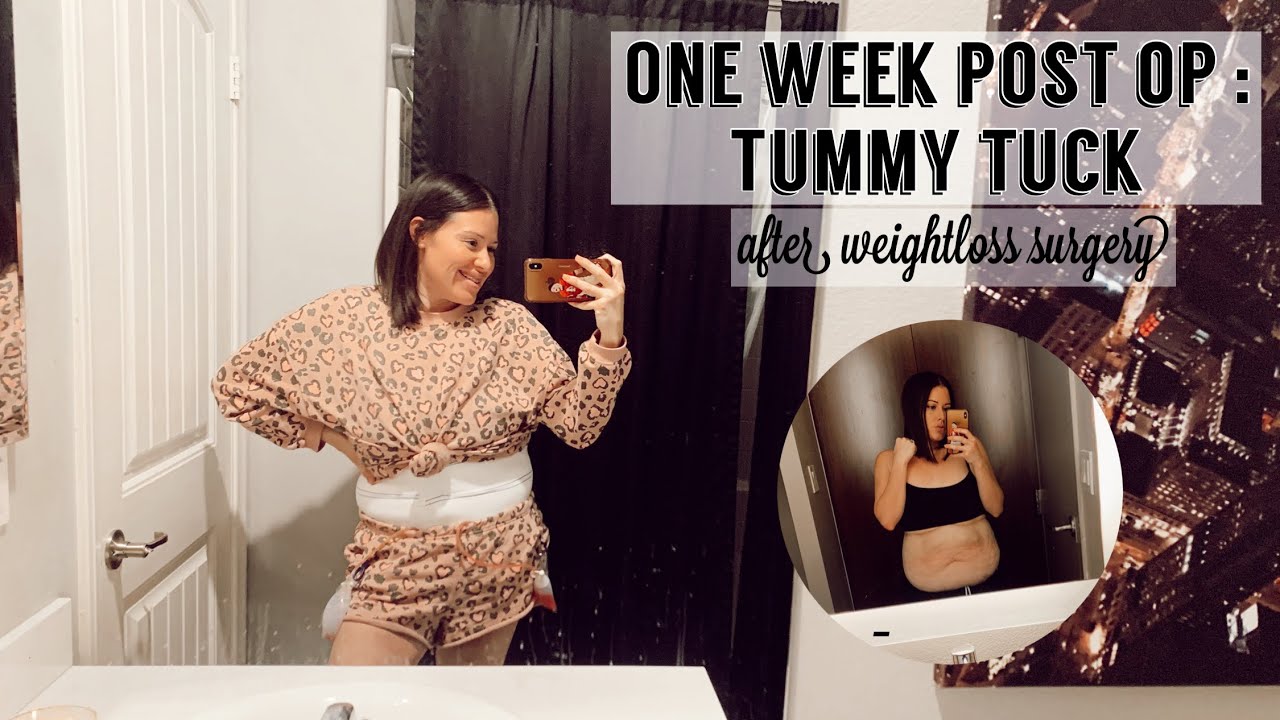 ONE WEEK POST OP TUMMY TUCK: AFTER WEIGHT LOSS SURGERY
