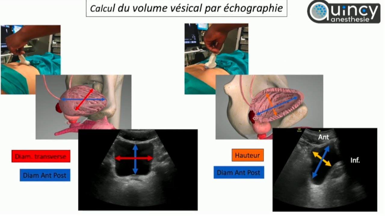 Evaluation du contenu vésical sous échographie