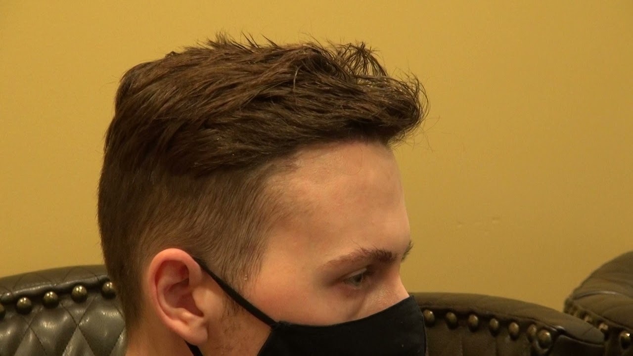 Receding Corners and Hair Line Restoration with Transplant by Dr. Diep