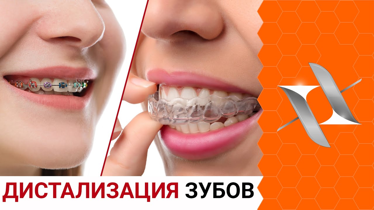 ДИСТАЛИЗАЦИЯ зубов в ортодонтии | Брекеты/элайнеры/аппараты.