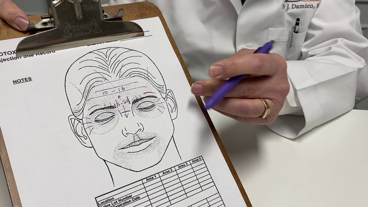 BOTOX 101: Crow's Feet
