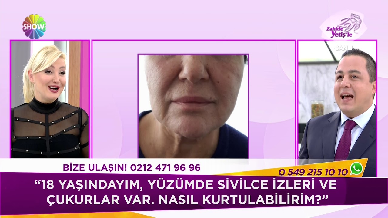 Kök Hücre Tedavisi sivilce izi ve çukurları yok ediyor!
