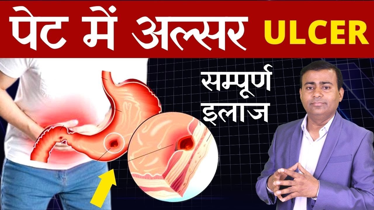 Complete treatment of stomach ulcer Peptic Ulcer Gastric Ulcer #ulcers treatment Duodenal Hindi