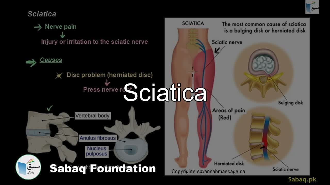 Sciatica, Biology Lecture | Sabaq.pk