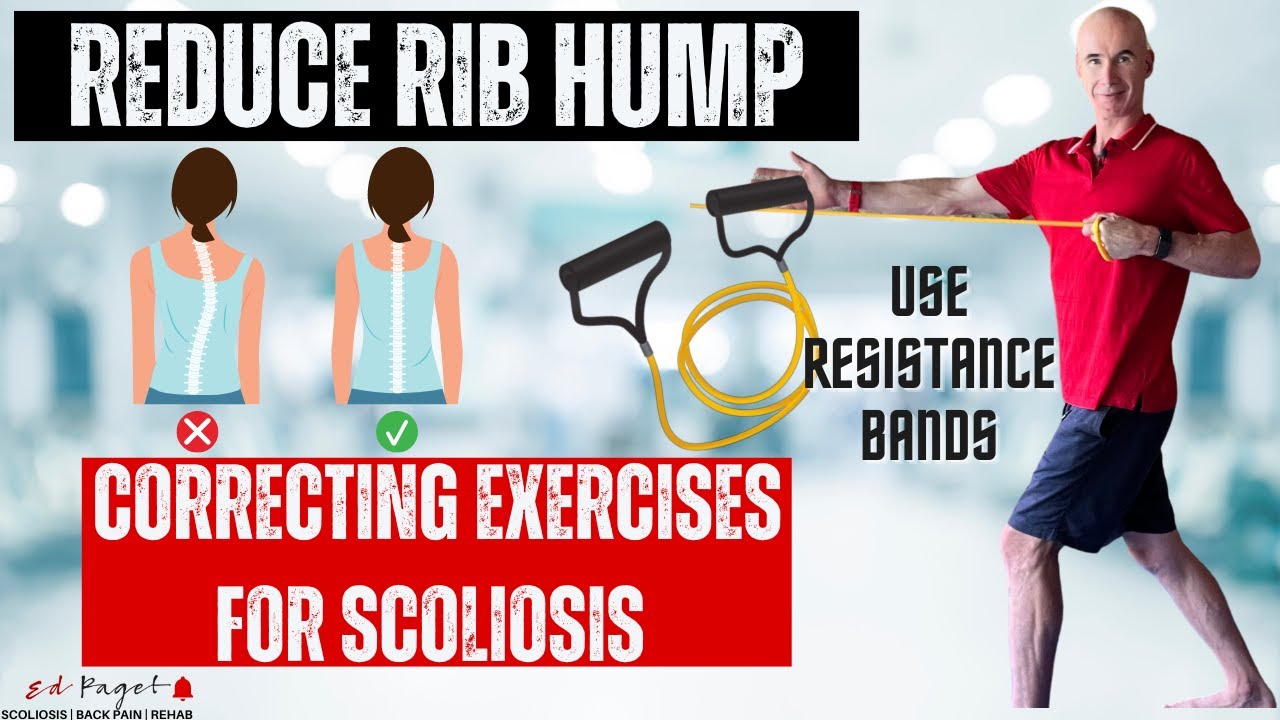 How To Fix Rib Hump | SCOLIOSIS
