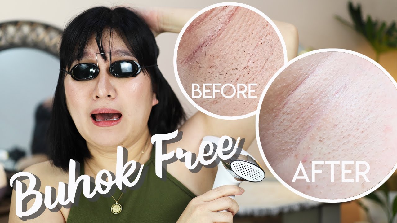PUMUTI at PUMINO ang Balat ko sa LASER HAIR REMOVAL  | Kris Lumagui