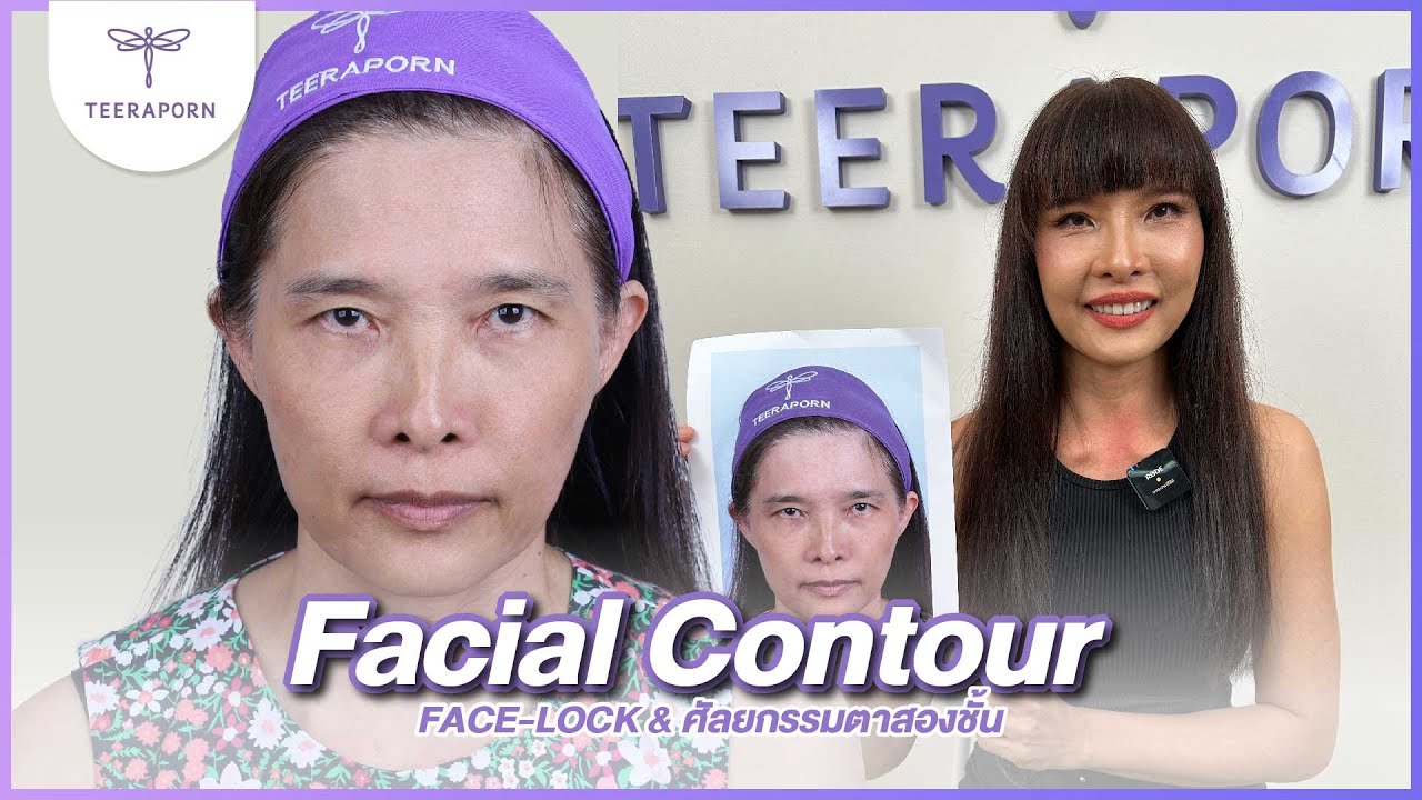 “ดึงหน้า Face-Lock ฉีด SVF ไขมันทั่วหน้า เติมเต็มทุกมิติพร้อมอัปเกรดศัลยกรรมตาสองชั้น บินตรงจากฮาวาย