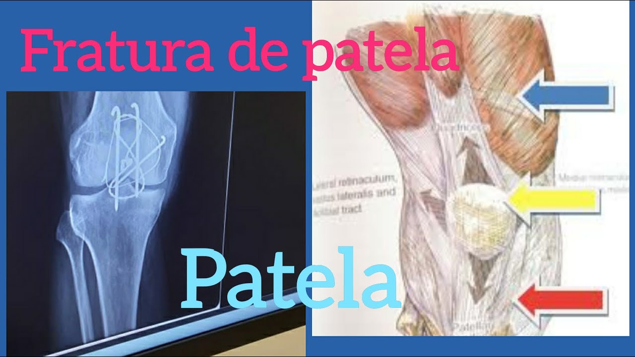 Fratura de patela fisioterapia no pos operatorio