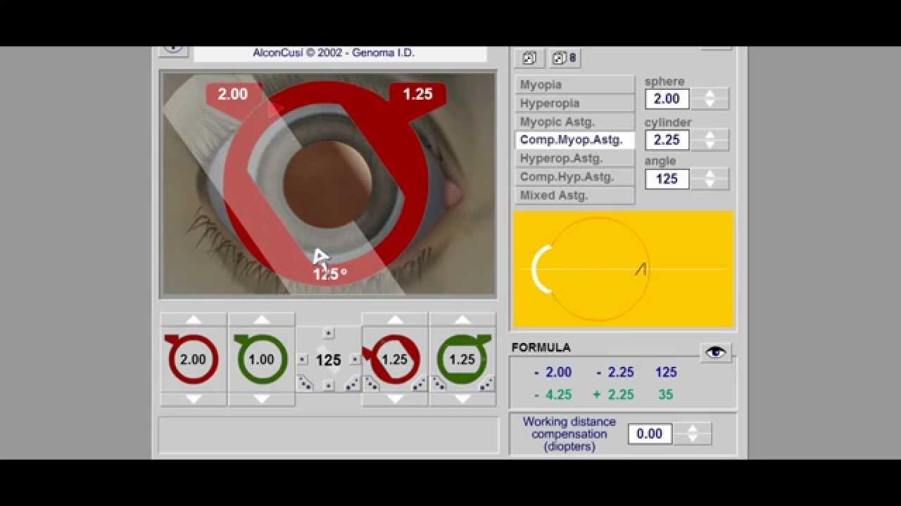 Retinoscopy Simulator Tutorial - Retinoscopy part 2