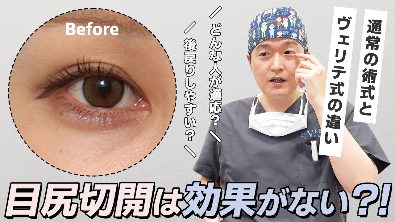 【美容整形】目尻切開は効果がないと言われる真相を美容外科医が解説。｜ヴェリテクリニック