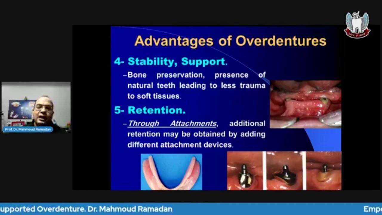 Tooth Supported Overdenture. Part 1: Advantages, Disadvantages, Indications & Contraindications