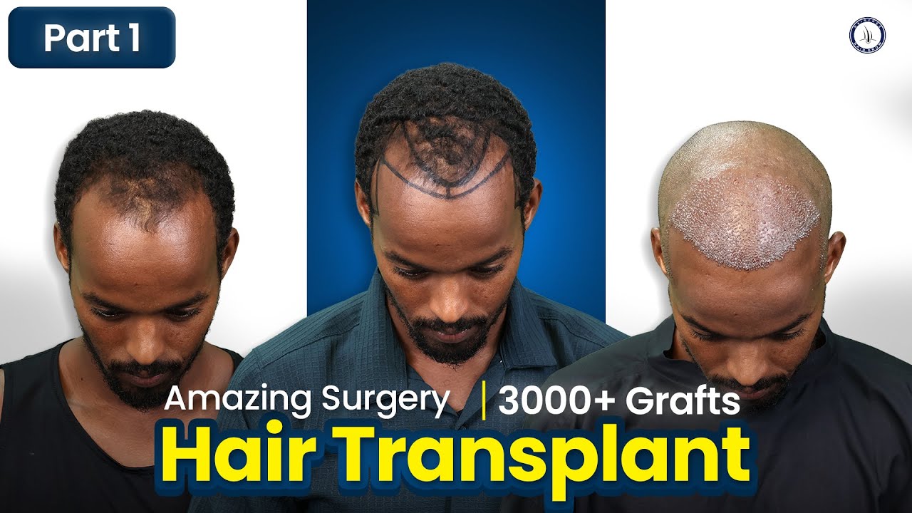 Hair Transplant Journey from Somaliland to Bangladesh | 3000 Grafts | Grade 3 | Hairfree & Hairgrow