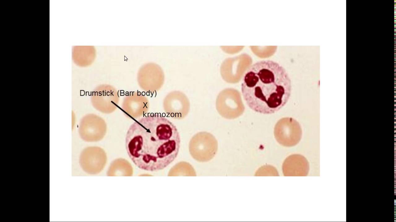 Hematoloji - Eritrosit Hastalıkları Histopatolojisi ve Lökosit Morfolojisi
