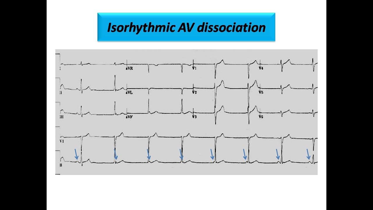 ECG course: Isorhythmic AV dissociation, Dr. Sherif Altoukhy