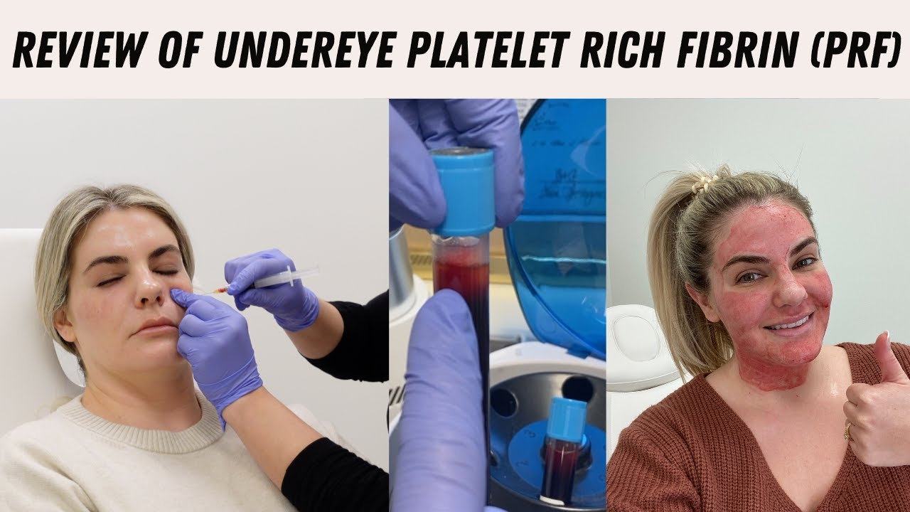 Undereye Platelet Rich Fibrin (PRF) Review
