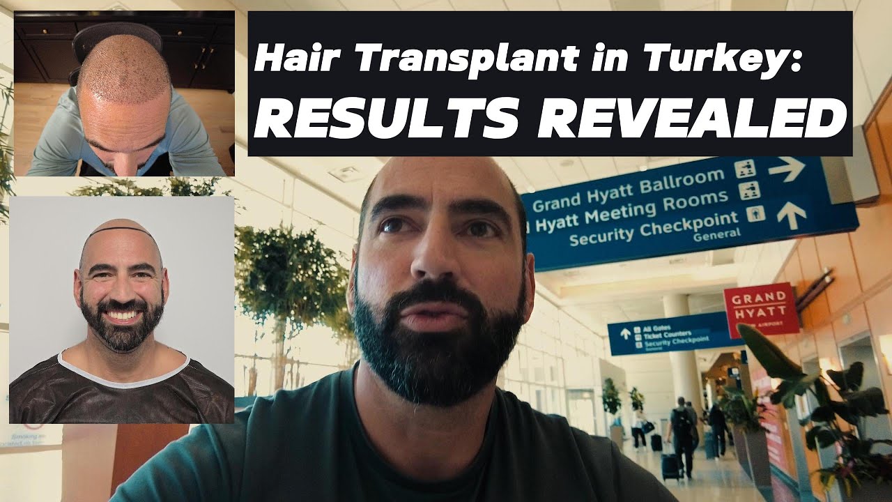 Was It Worth It? My Hair Transplant Experience in Turkey!