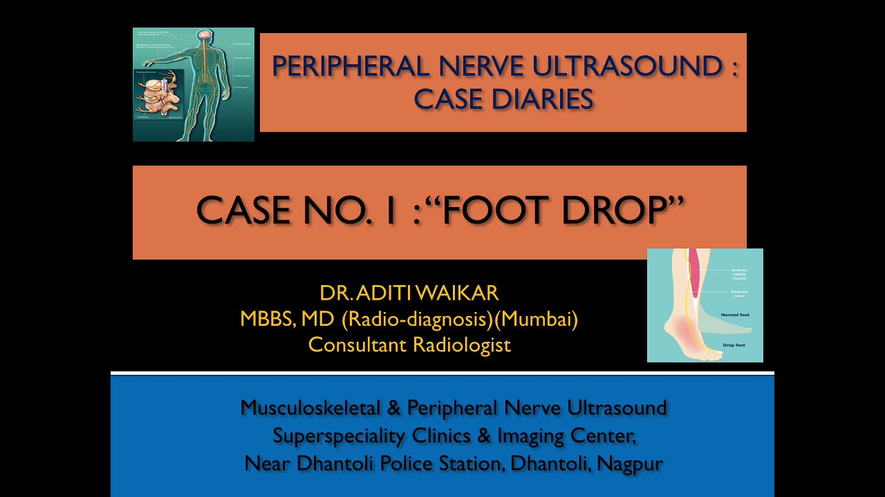Peripheral Nerve Ultrasound Diaries : Case no. 1 : Foot Drop