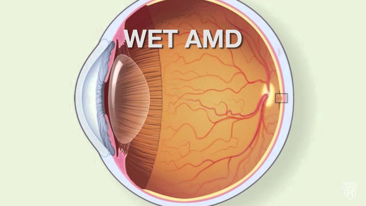 Mayo Clinic Minute: Age-related Macular Degeneration
