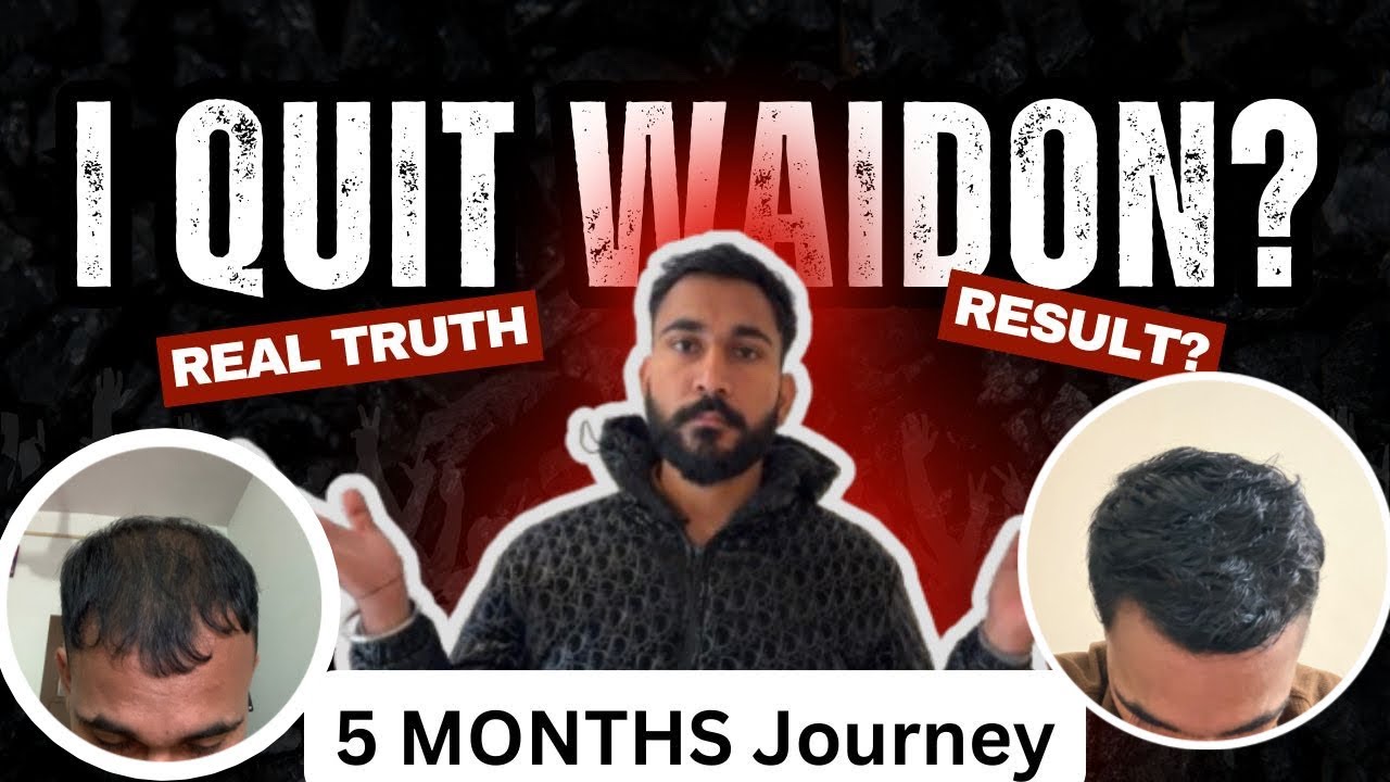 5 Months Hair Regrowth Journey 😳 | 5th Month Me Hairfall Badh Gaya & Doctor Consult Update 