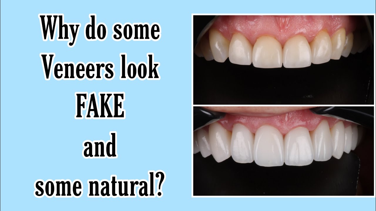 Fake vs. Natural looking Dental Veneers