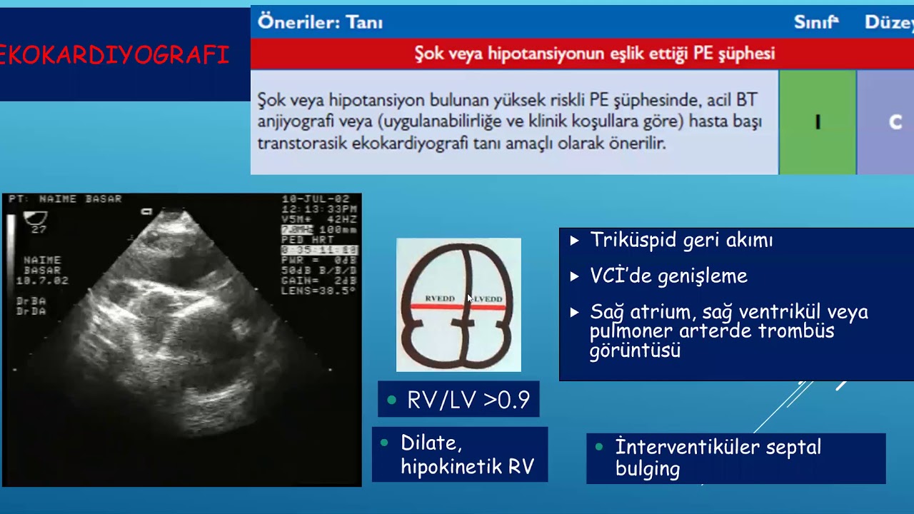 Pulmoner emboli - Prof. Dr. Neşe Dursunoğlu - 01052020