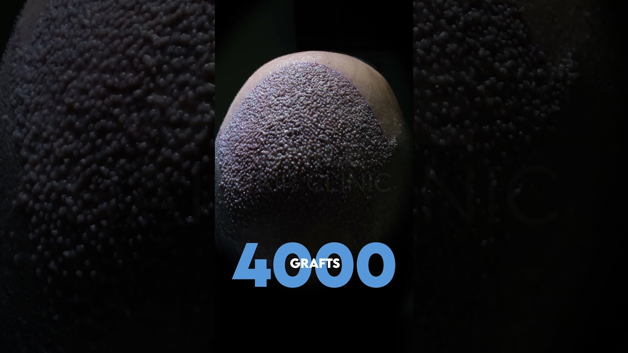 HAIR TRANSPLANT 4000 GRAFTS AFTER OPERATION - SMILE HAIR CLINIC  #hairtransplantturkey