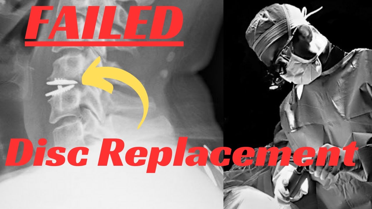 Failed disc replacement: How I fixed it.