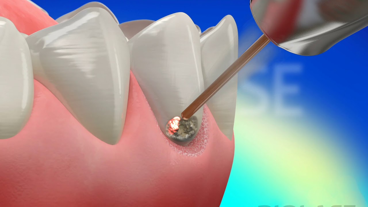Restorative Class V - Waterlase Laser Dentistry