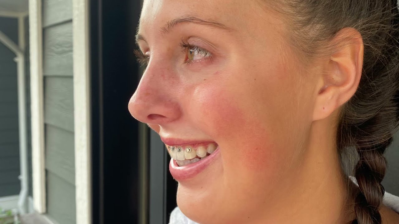 DOUBLE JAW SURGERY!! Pre/post op updates and 1 week post op!