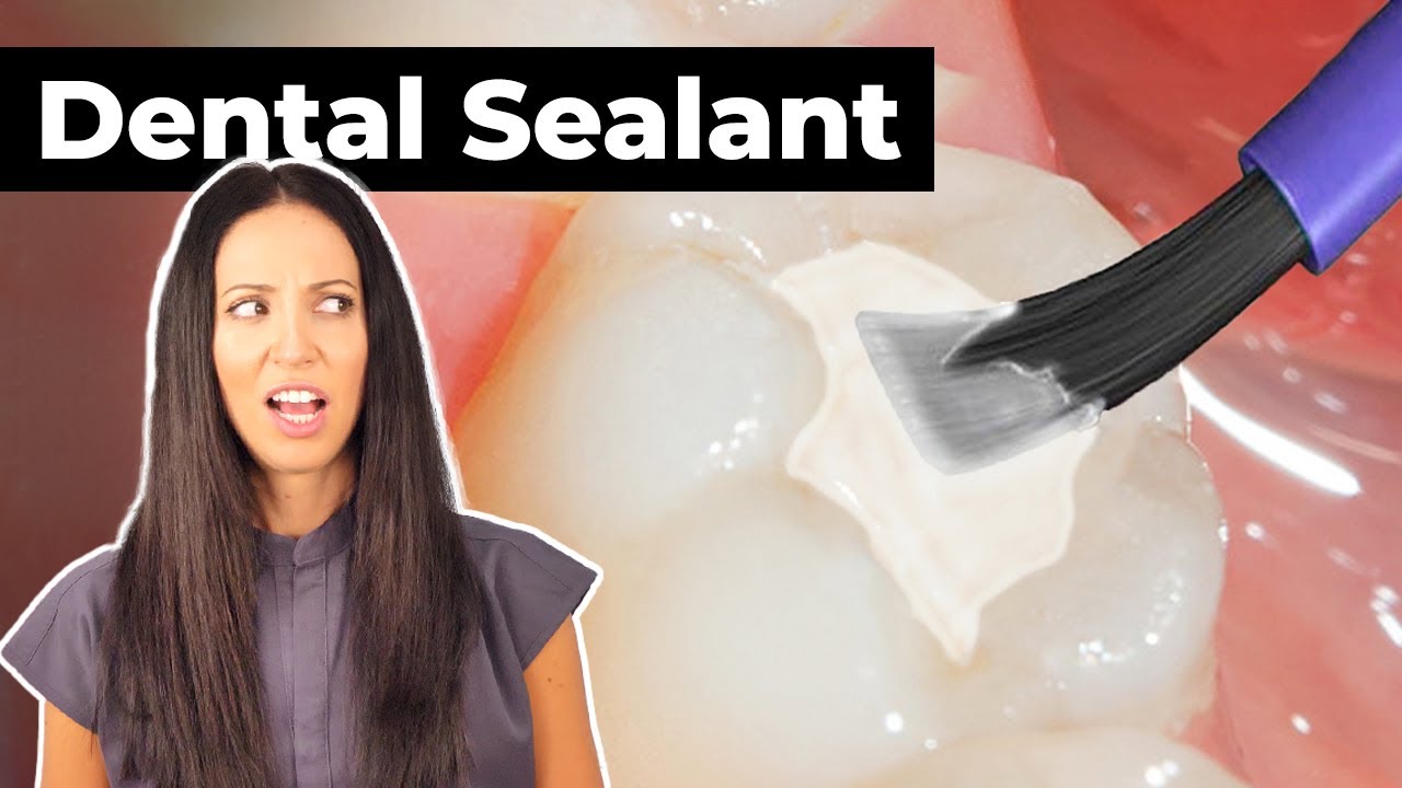 how LIQUID PLASTIC helps PROTECT your teeth (Sealants Explained)